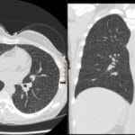 Axial and coronal lung-window CT displays diffuse, bilateral centrilobular tiny nodules throughout both pulmonary fields.