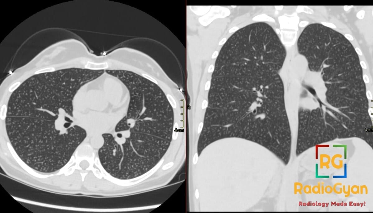 Axial and coronal lung-window CT displays diffuse, bilateral centrilobular tiny nodules throughout both pulmonary fields.
