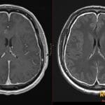 Axial brain MRI showing bilateral subdural effusions and smooth diffuse pachymeningeal enhancement in intracranial hypotension