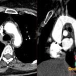 Axial CT angiography showing Takayasu arteritis with thoracic aortic wall thickening extending into the great vessels