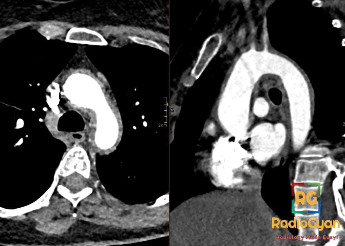 Axial CT angiography showing Takayasu arteritis with thoracic aortic wall thickening extending into the great vessels