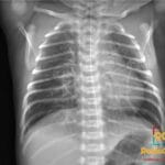 Neonatal chest X-ray showing perihilar interstitial edema with trace fluid in the right minor fissure, consistent with TTN.