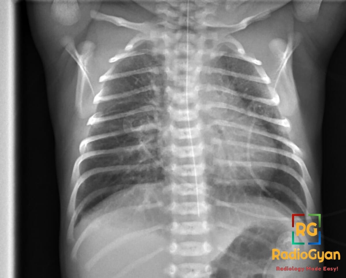 Neonatal chest X-ray showing perihilar interstitial edema with trace fluid in the right minor fissure, consistent with TTN.