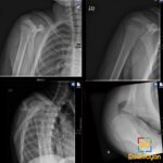 AP and axillary right shoulder radiographs show AC joint widening with inferior scapular displacement, an AC separation.