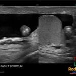Sagittal left scrotal ultrasound showing a mobile echogenic scrotal pearl with central calcification within hydrocele fluid