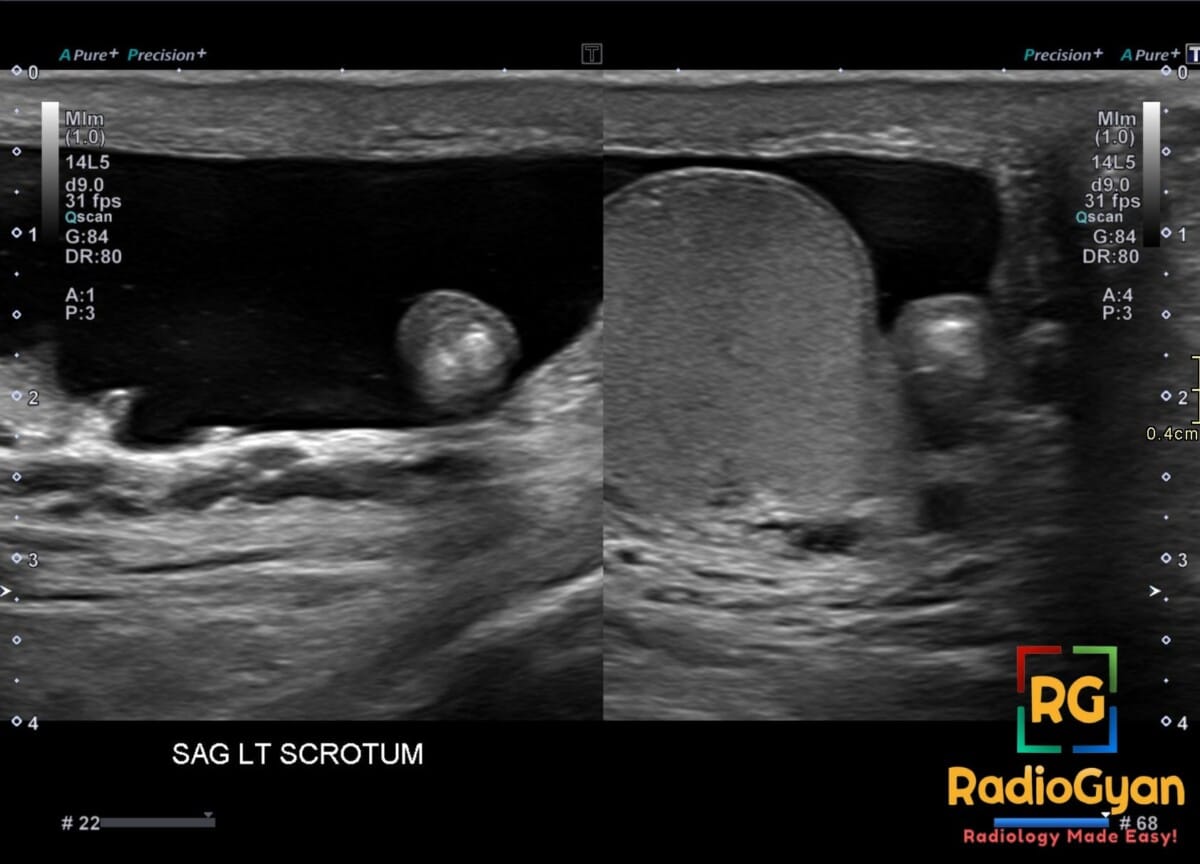 Sagittal left scrotal ultrasound showing a mobile echogenic scrotal pearl with central calcification within hydrocele fluid