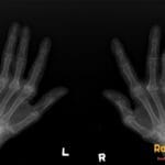 Bilateral PA hand X-ray showing advanced rheumatoid arthritis with MCP erosions, subluxations, and carpal bone involvement