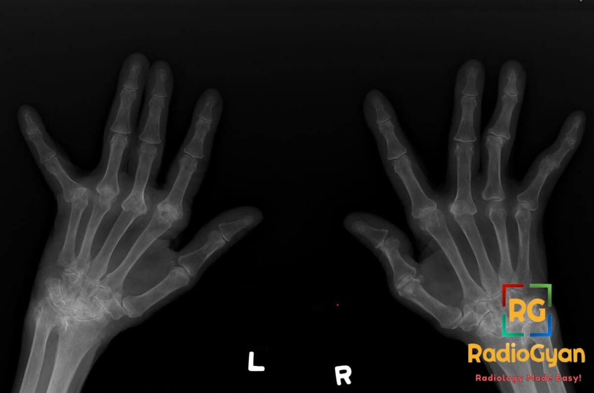 Bilateral PA hand X-ray showing advanced rheumatoid arthritis with MCP erosions, subluxations, and carpal bone involvement