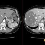 Axial arterial and portal venous phase CT showing giant right hepatic lobe hemangioma with nodular discontinuous enhancement