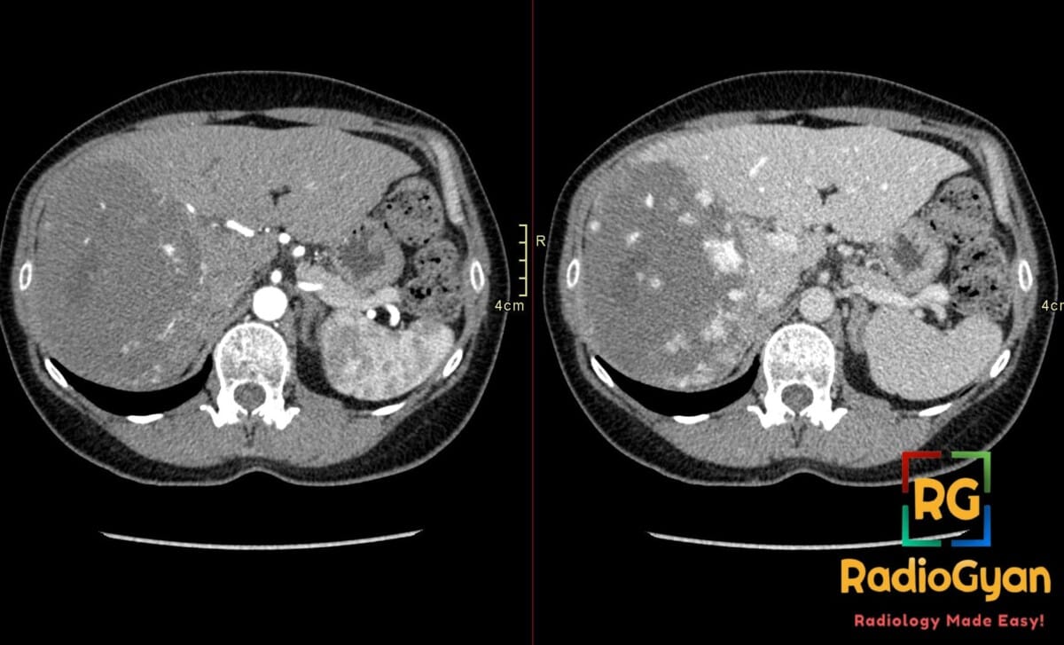 Axial arterial and portal venous phase CT showing giant right hepatic lobe hemangioma with nodular discontinuous enhancement
