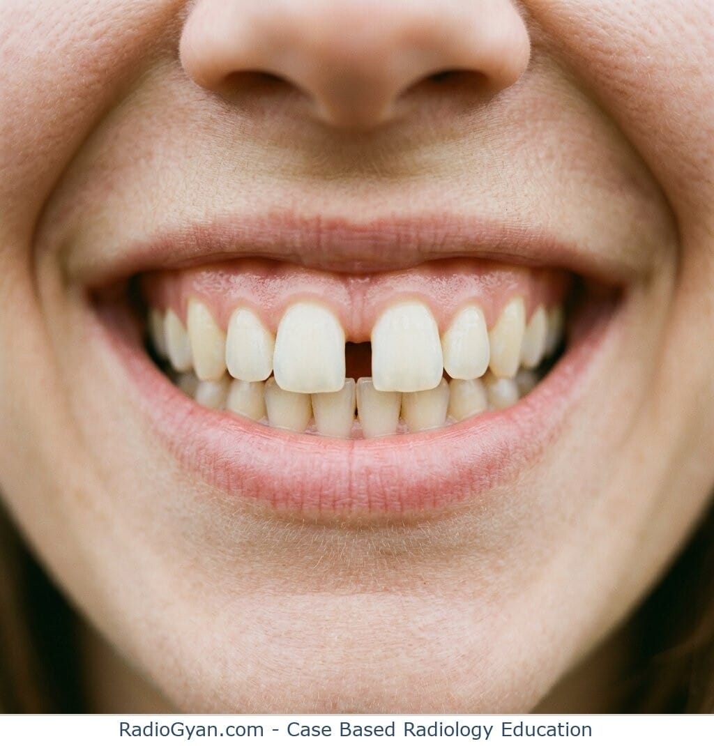 A broad grin with a wide gap between the two upper front incisors, the dental diastema that inspired the name of the Terry-Thomas sign.