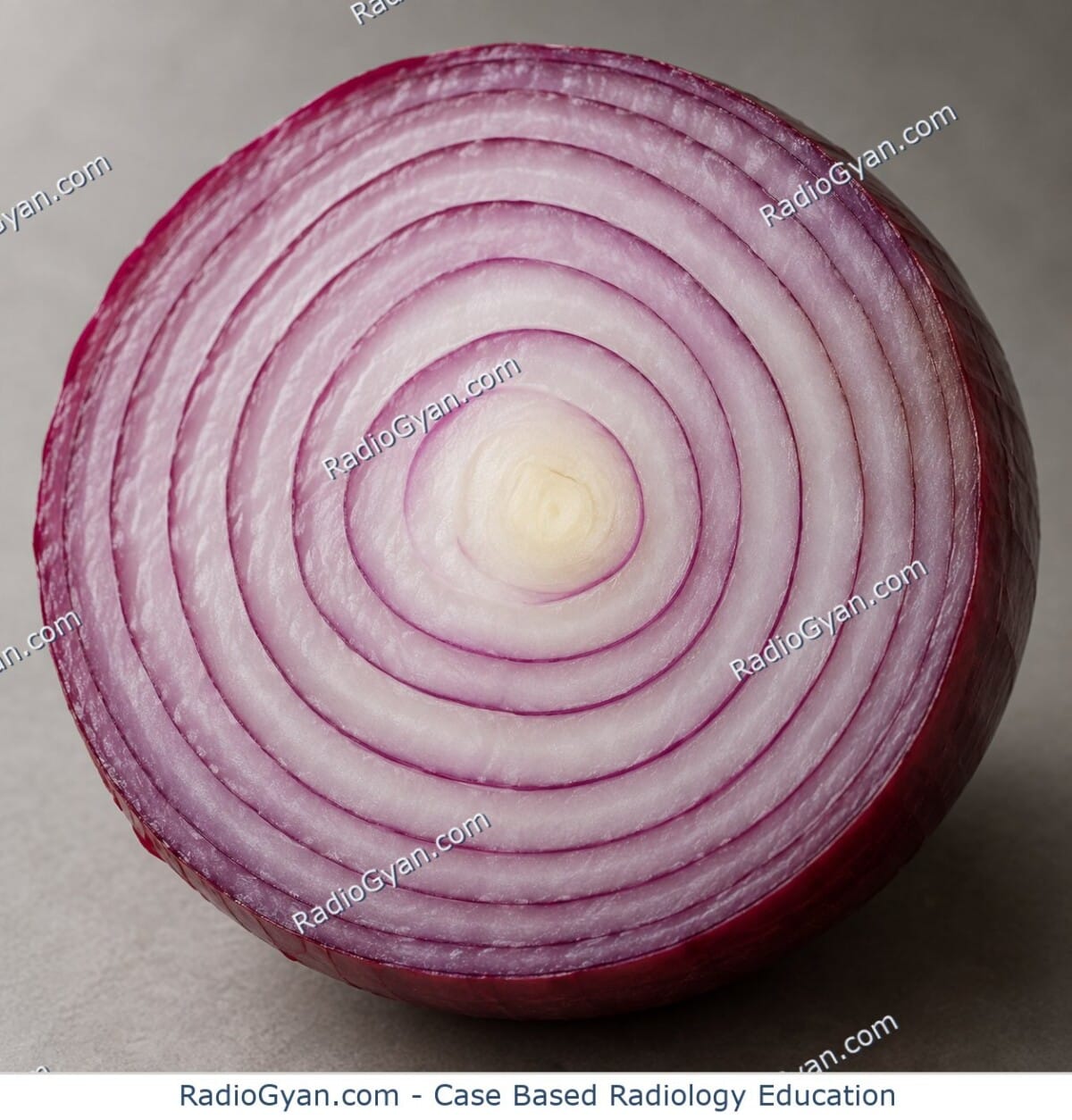 Cross-section of a red onion showing the concentric layers that give onion-skin periosteal reaction its name.