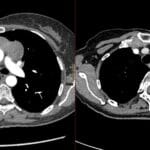 Axial contrast-enhanced chest CT showing anterior mediastinal thymoma with left pleural drop metastasis along the chest wall