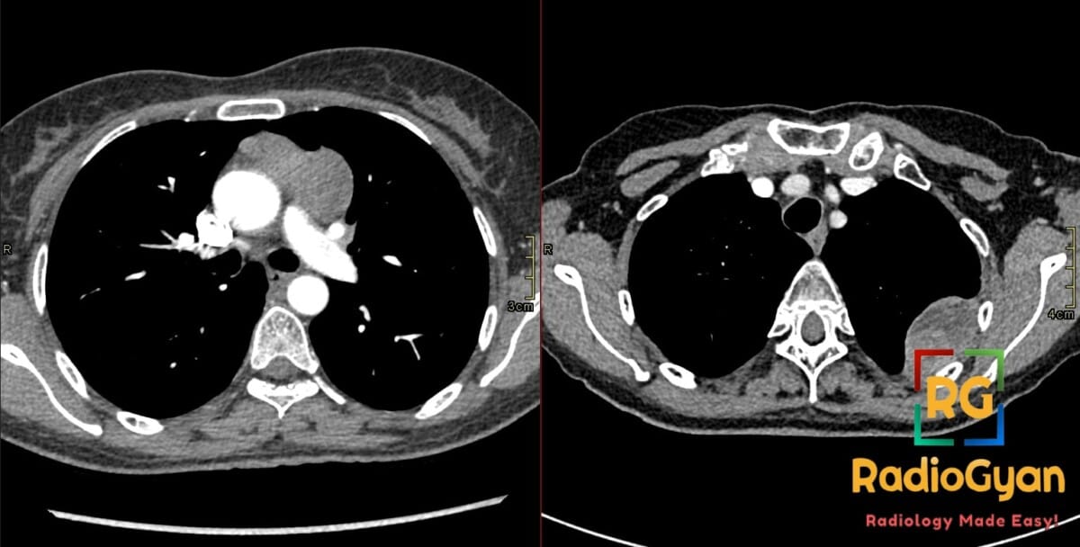 Axial contrast-enhanced chest CT showing anterior mediastinal thymoma with left pleural drop metastasis along the chest wall