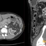 Axial and sagittal CECT abdomen of a large left renal angiomyolipoma with fat density and an intratumoral aneurysm