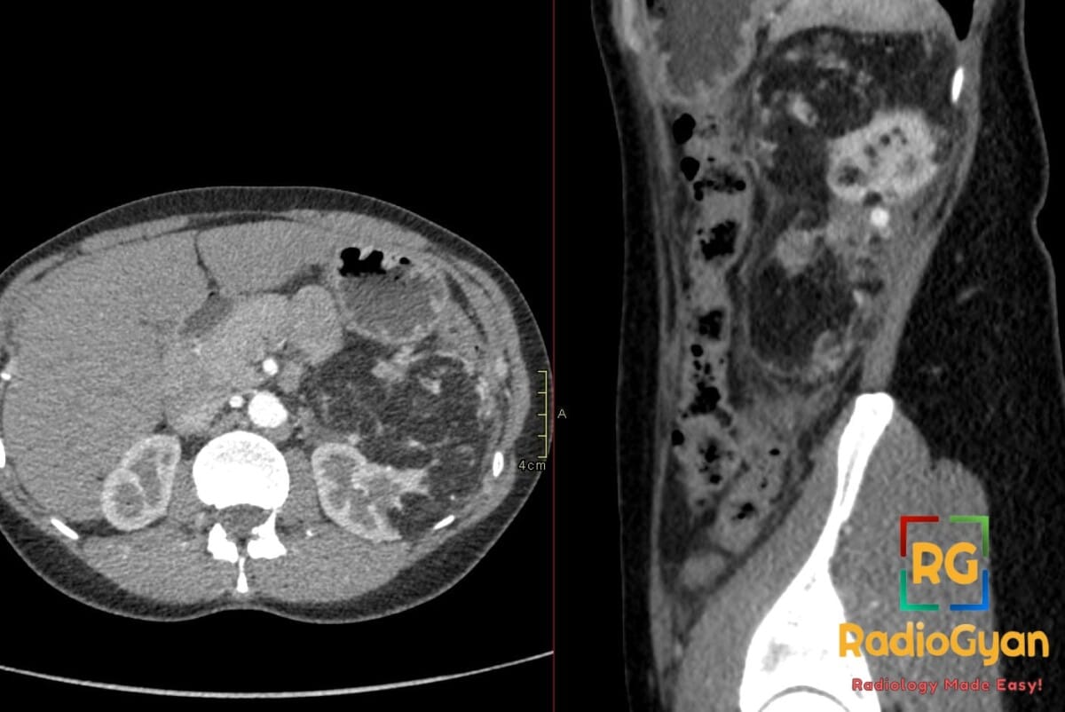 Axial and sagittal CECT abdomen of a large left renal angiomyolipoma with fat density and an intratumoral aneurysm