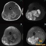 Axial right thigh MRI shows a large multilobulated posterior muscle mass with T2-bright myxoid tissue and hemorrhage.