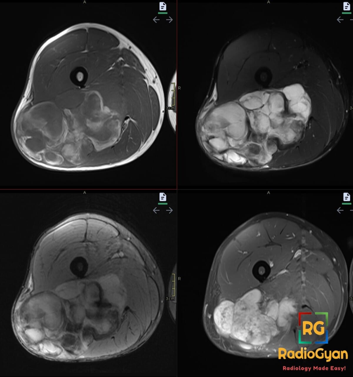 Axial right thigh MRI shows a large multilobulated posterior muscle mass with T2-bright myxoid tissue and hemorrhage.