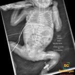 Frontal neonatal abdominal X-ray shows a left femoral PICC coiled at the iliac veins instead of ascending centrally.