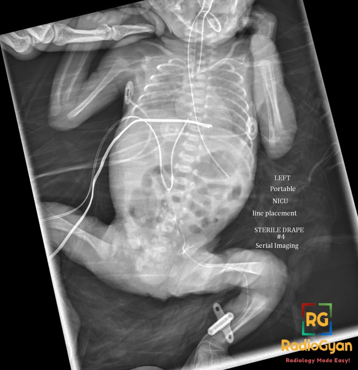 Frontal neonatal abdominal X-ray shows a left femoral PICC coiled at the iliac veins instead of ascending centrally.
