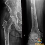 Frontal radiographs of the right femur and pelvis showing numerous punched-out lytic lesions of multiple myeloma