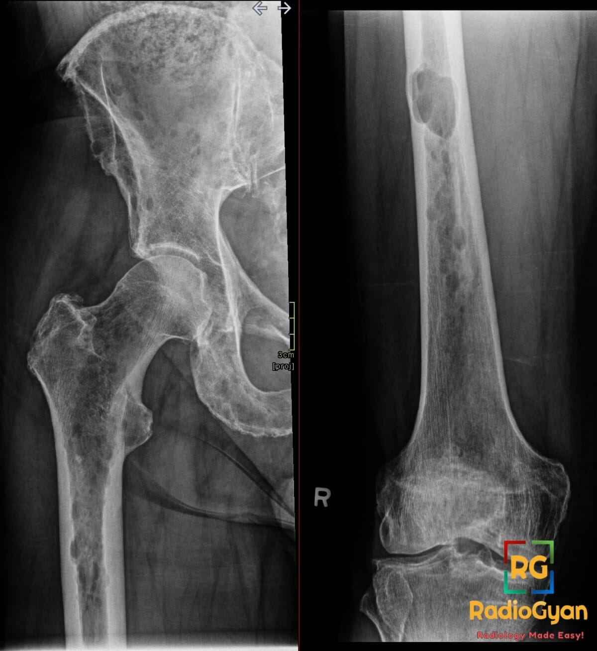 Frontal radiographs of the right femur and pelvis showing numerous punched-out lytic lesions of multiple myeloma