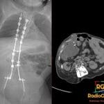 Composite CT: scanogram tracks VP shunt to left neck; axial abdomen shows large right peritoneal CSF collection (CSFoma)