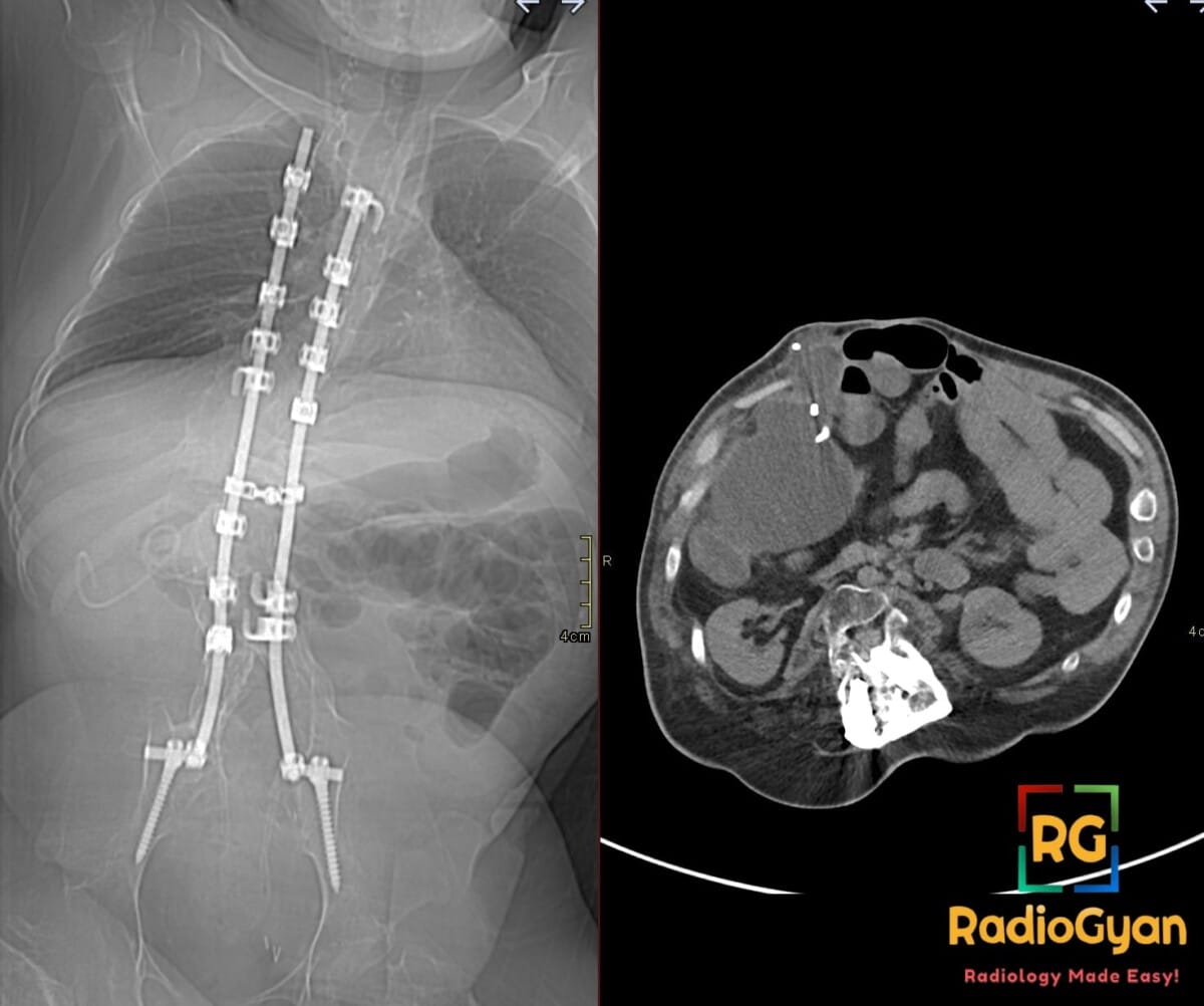 Composite CT: scanogram tracks VP shunt to left neck; axial abdomen shows large right peritoneal CSF collection (CSFoma)