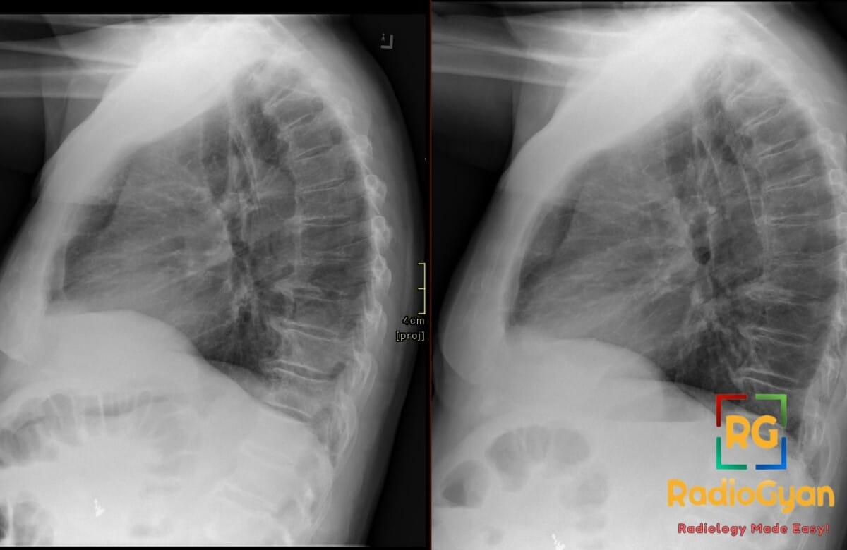 Paired lateral chest X-rays showing increased lower lobe density, lost spine lucency, consistent with pneumonia