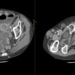 Axial contrast-enhanced pelvic CT showing a right obturator canal hernia with distended proximal small bowel loops