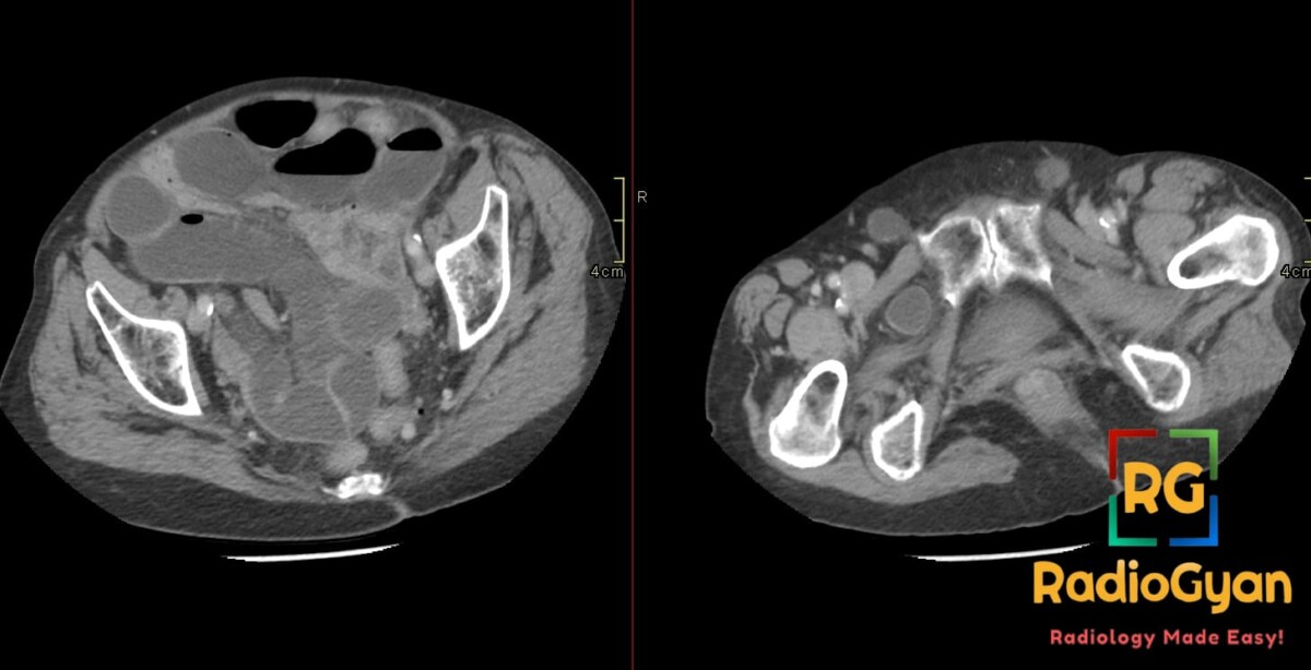 Axial contrast-enhanced pelvic CT showing a right obturator canal hernia with distended proximal small bowel loops