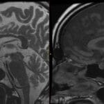 Sagittal T2 and T1 MRI showing a well-defined cyst in the pituitary fossa of the sella, bright on T2 and dark on T1