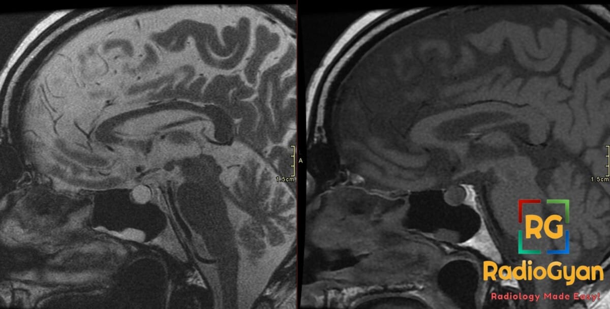 Sagittal T2 and T1 MRI showing a well-defined cyst in the pituitary fossa of the sella, bright on T2 and dark on T1