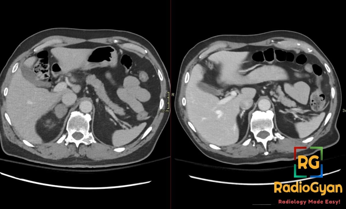 Axial follow-up abdominal CT showing dense calcification of the right adrenal gland, a benign sequela of prior hemorrhage.