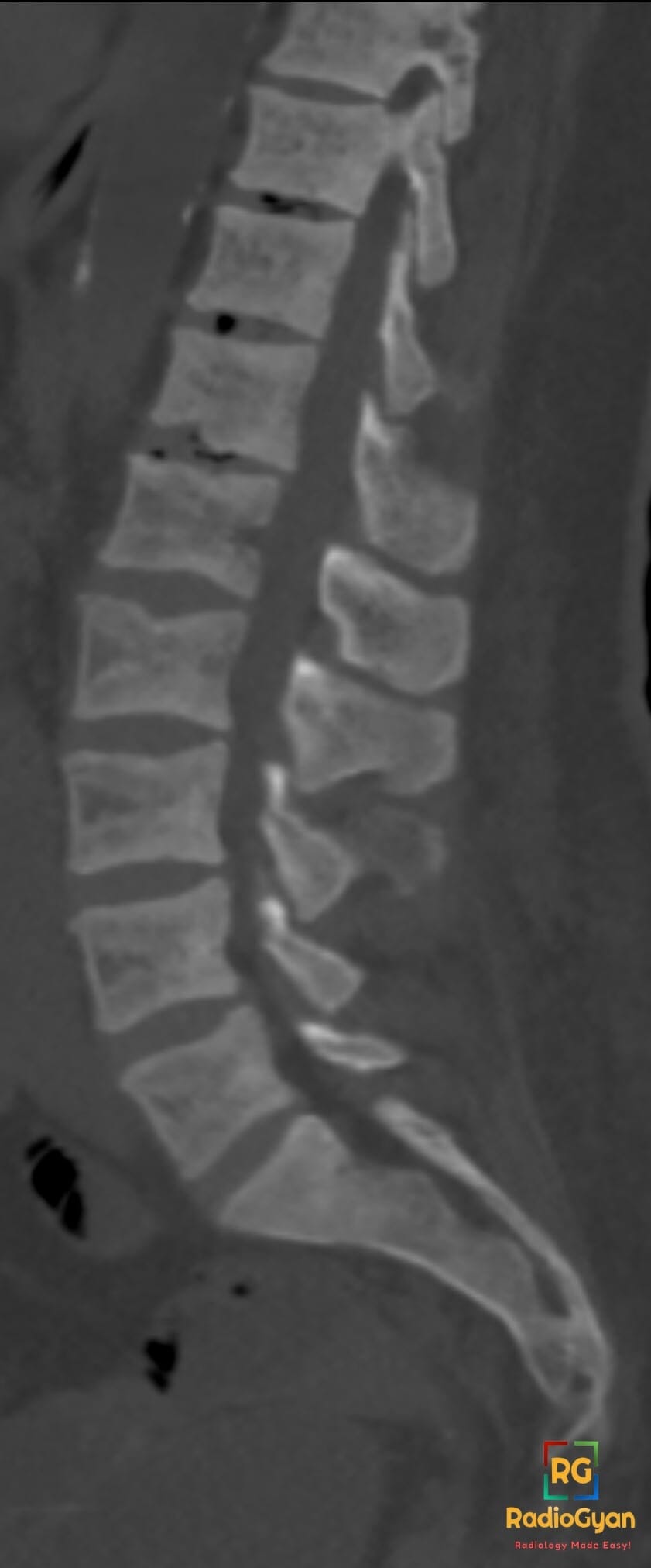 Sagittal lumbar spine CT shows rugger jersey sign with dense endplate bands and central osteopenia from renal osteodystrophy
