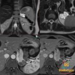Coronal and axial T2 MRI show a lobulated bunch-of-grapes lesion in the pancreatic tail without post-contrast enhancement.