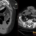 Coronal and axial CT of the abdomen showing dilated small bowel loops with air-fluid levels and a midline umbilical hernia