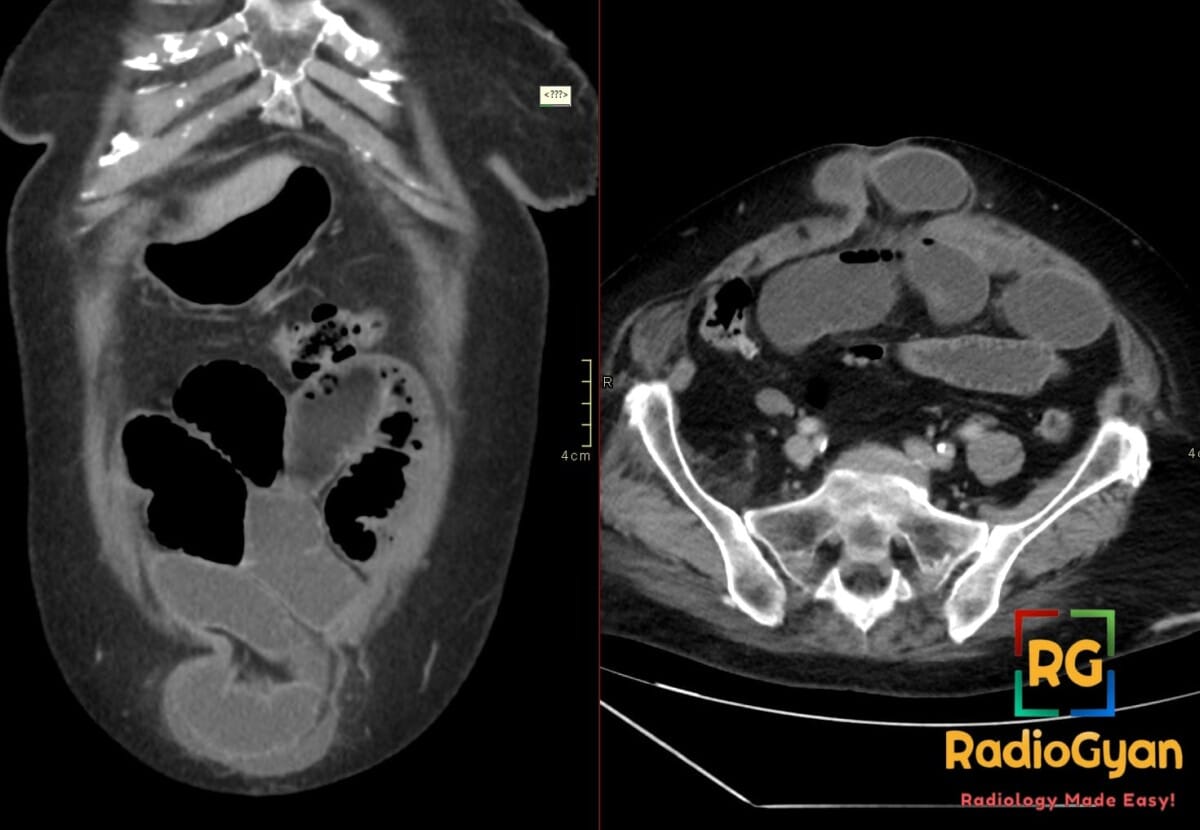 Coronal and axial CT of the abdomen showing dilated small bowel loops with air-fluid levels and a midline umbilical hernia