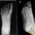 AP and oblique left foot X-rays show an acute avulsion fracture of the fifth metatarsal apophysis with mild displacement.