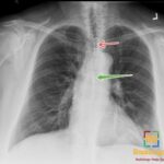 Frontal chest X-ray shows left lower lobe pneumonia with retrocardiac opacity and anterior and posterior junctional lines