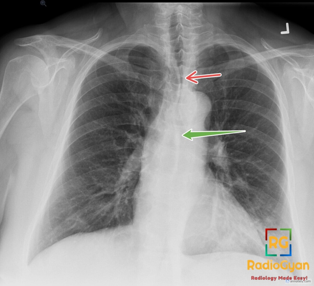 Frontal chest X-ray shows left lower lobe pneumonia with retrocardiac opacity and anterior and posterior junctional lines