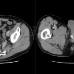 Axial CT shows an artificial urinary sphincter with right lower quadrant bulb and urethral cuff at the penile base.