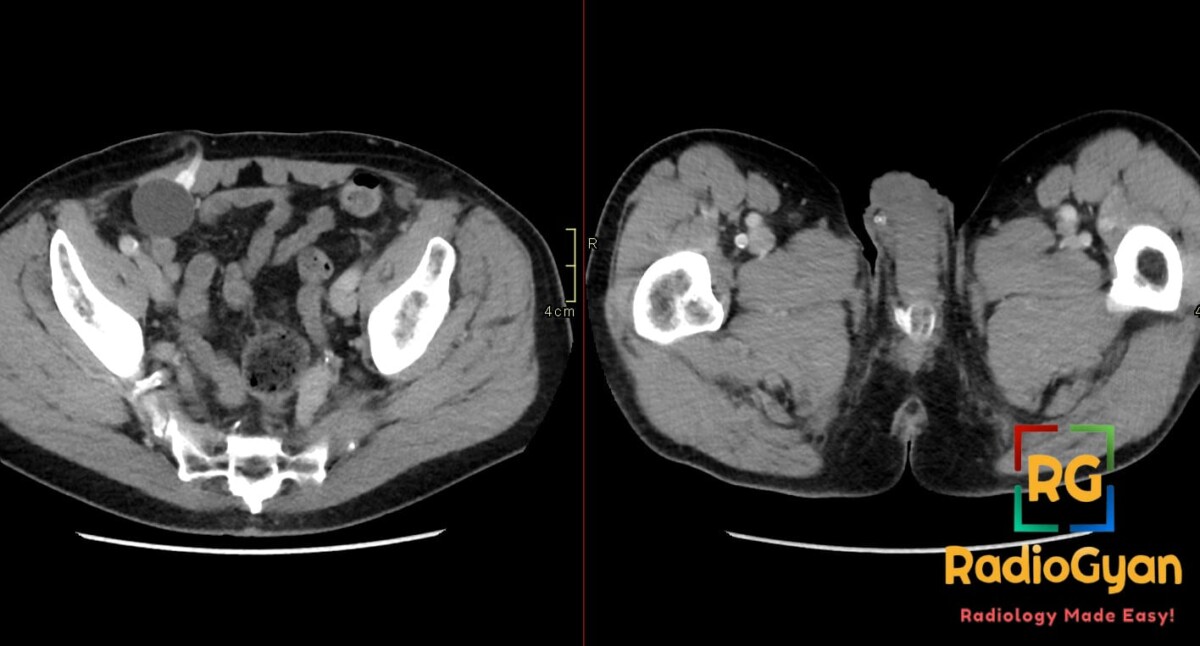 Axial CT shows an artificial urinary sphincter with right lower quadrant bulb and urethral cuff at the penile base.