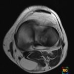 Axial right knee MRI shows posteromedial Baker cyst with speech bubble sign and gastrocnemius-semimembranosus fluid.