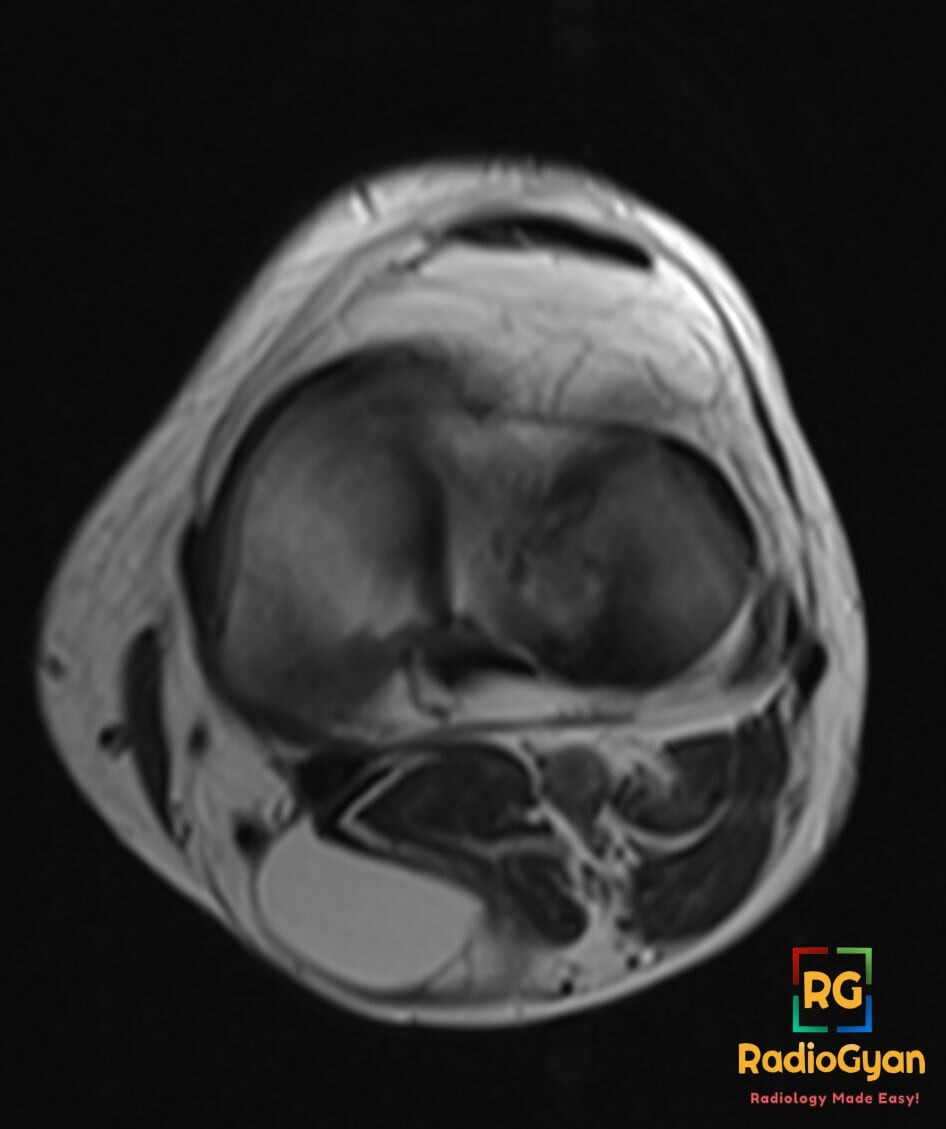 Axial right knee MRI shows posteromedial Baker cyst with speech bubble sign and gastrocnemius-semimembranosus fluid.