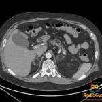 Axial contrast-enhanced CT shows bilateral adrenal myelolipomas with macroscopic fat and thin soft-tissue rims.