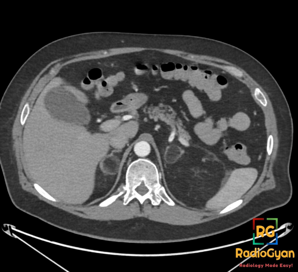Axial contrast-enhanced CT shows bilateral adrenal myelolipomas with macroscopic fat and thin soft-tissue rims.