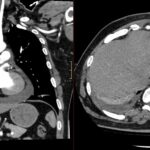 Coronal and axial contrast chest CT showing pericardial effusion and a small left pleural effusion after myocardial infarction