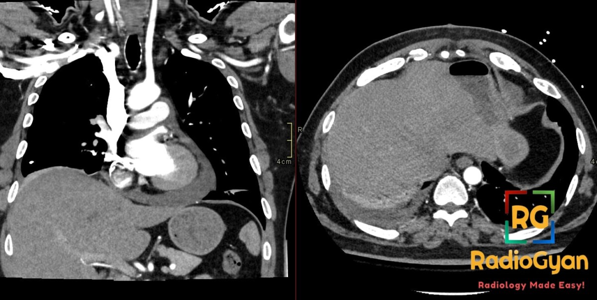 Coronal and axial contrast chest CT showing pericardial effusion and a small left pleural effusion after myocardial infarction