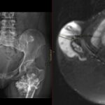 Axial pelvic MRI shows a right iliac osteochondroma with a thick 2.37-cm cartilage cap, suggesting malignant transformation.